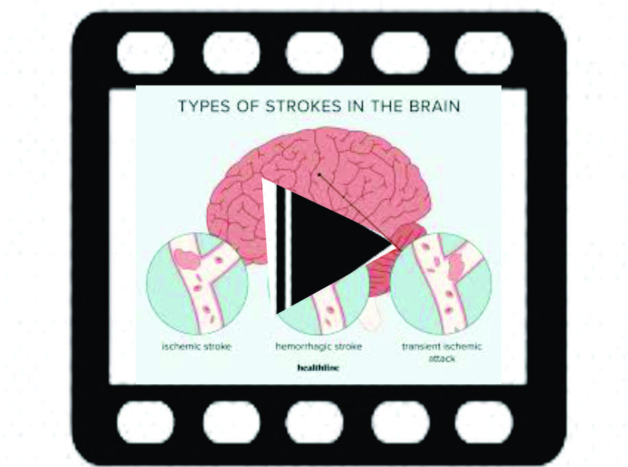 Dr. Ungar Talks about Religion & Medicine During Passover 85 DR UNGAR VIDEO ON STROKE