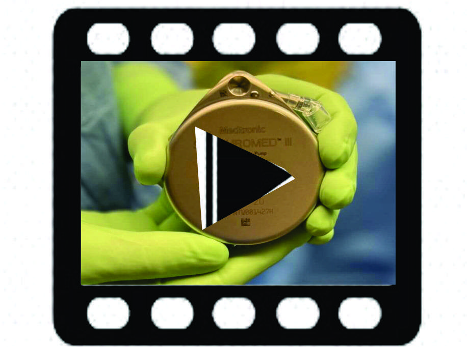 dr ungar sargon refills intrathecal pain pump