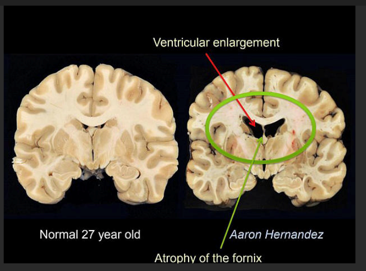 Neurologist Dr Ungar Talks about CTE Brain Damage And the New York Shooter